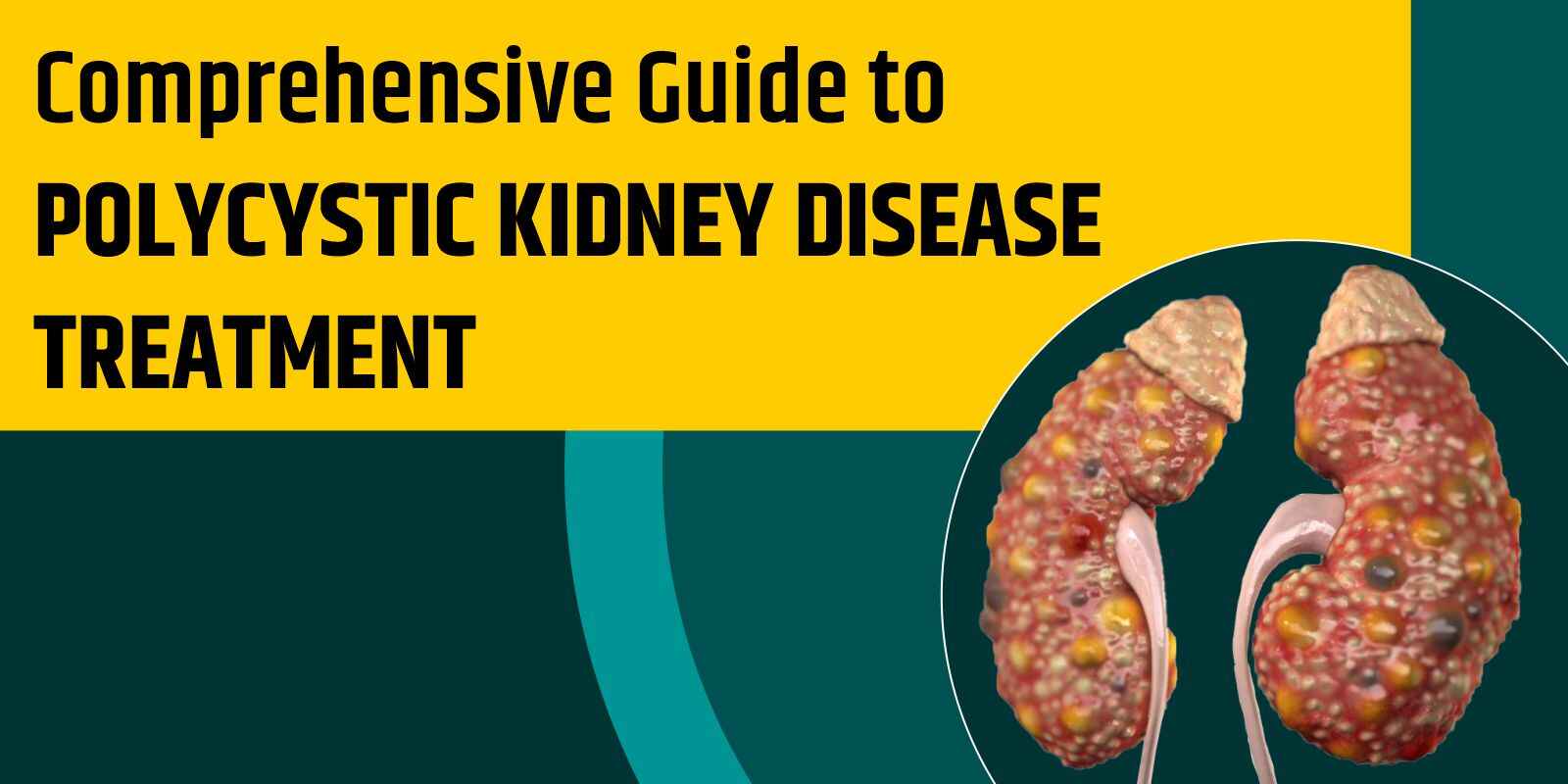 Polycystic Kidney Disease â€“ A deep dive to its types and treatment
