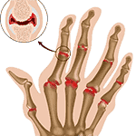 Arthritis Treatment