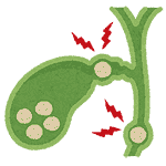 Gallbladder Stone Treatment